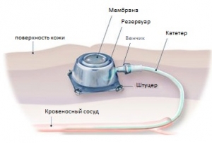 central-venous-access-device-cvad.jpg