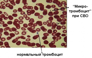 Вид мазка крови при СВО. Видны уменьшенные тромбоциты